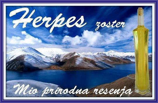 Herpes zoster